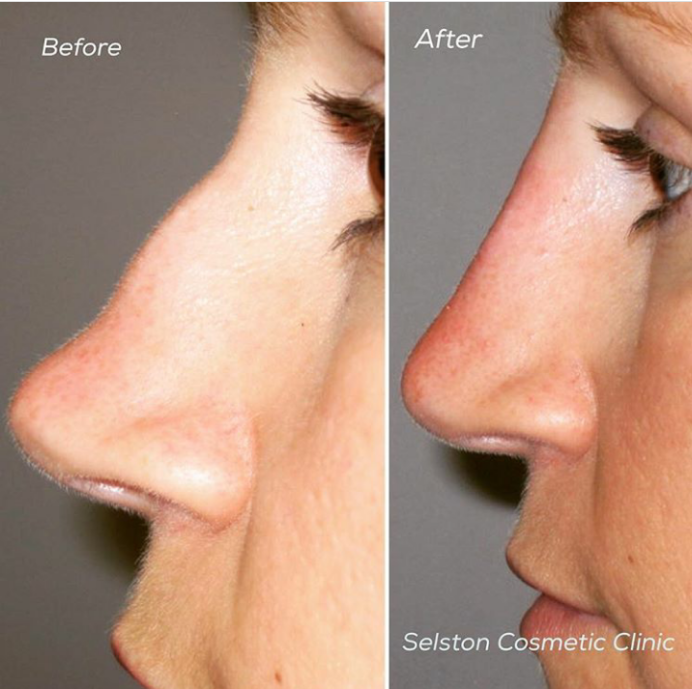 Selston Cosmetic Clinic Correct Your Bumpy Uneven Nose with Dermal