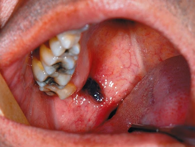 PDF: Atypical Lesion on Soft Palate - A Curious Case