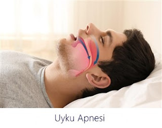 uyku apnesi nedir nasil tedavi edilir