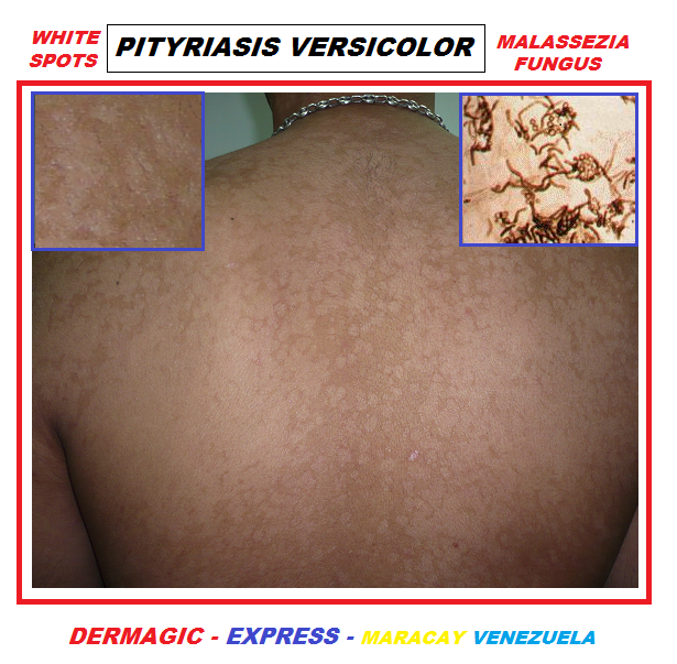 Dermagic Express Dermatologia Y Bibliografia Dermatology Bibliography The Pityriasis Versicolor A Review La Pitiriasis Versicolor Revision