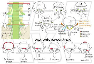 Anatomía topográfica hernia discal