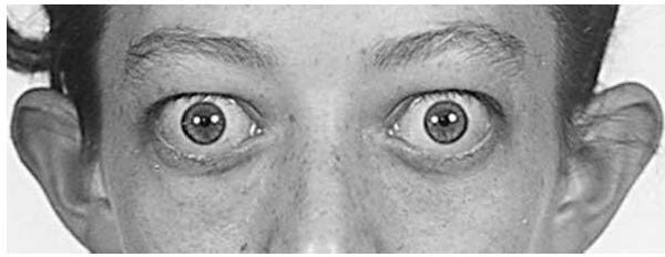 Exophthalmos and proptosis of Graves disease