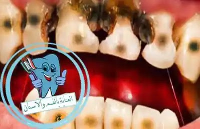 علاج تسوس الاسنان الامامية طبيا ومنزليا