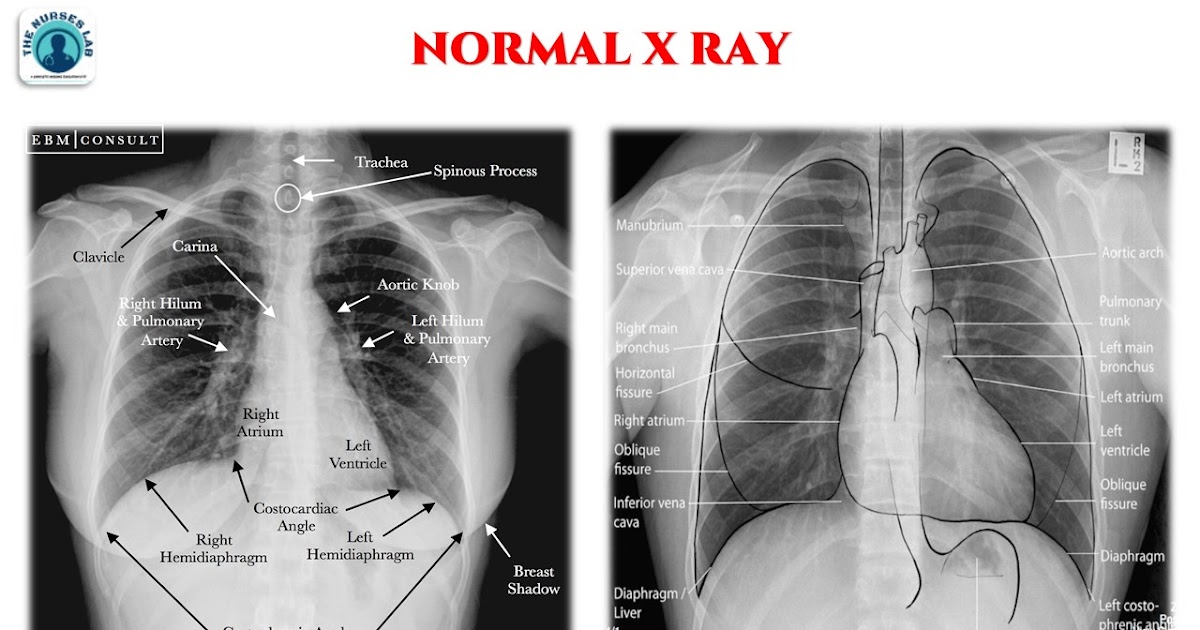 Abnormal Chest Xray Interpretation