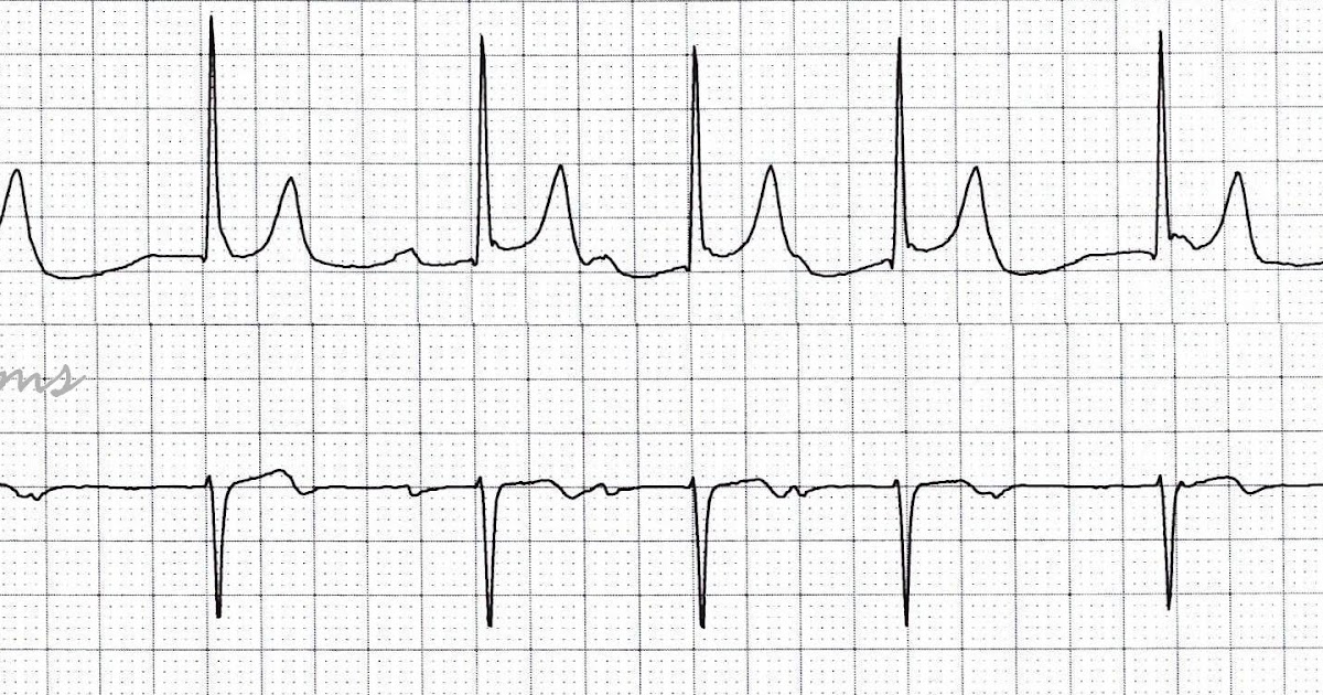 ECG Rhythms SR, Second Degree AV Block Type I, Junctional Escape Beats