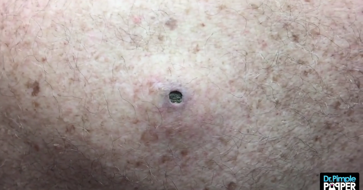 Pimple poppers delight