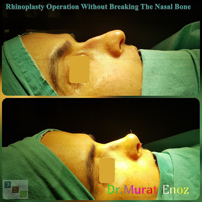 Nasal aesthetic surgery without breaking the nasal bone,Rhinoplasty without breaking bone,Nose job without breaking bone,Rhinoplasty in İstanbul Turkey,