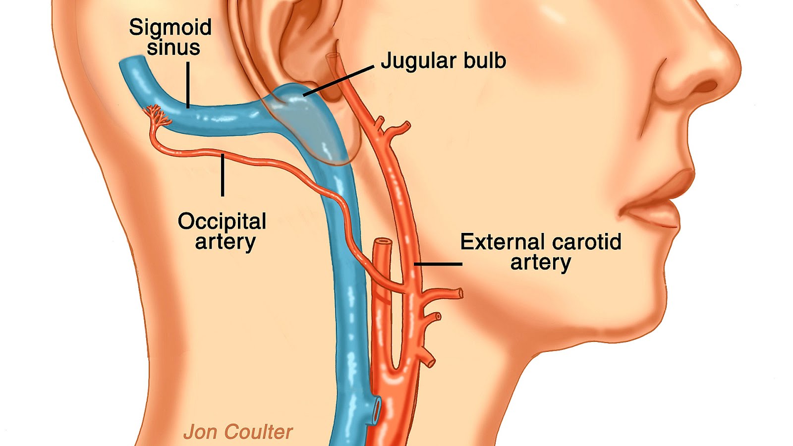 Hear Heartbeat Can High Blood Pressure Cause Pulsatile Tinnitus