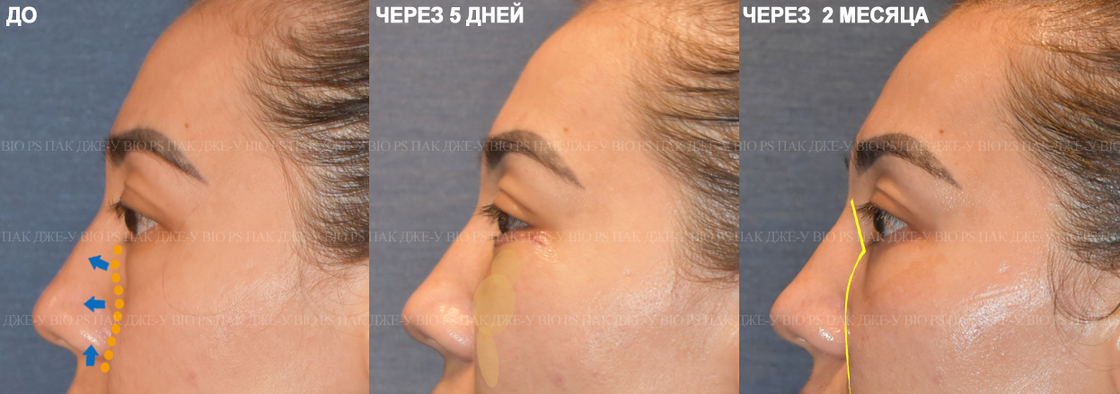 пластическая хирургия смас. биос пластическая хирургия. смас лица и шеи операция паттайя. биос пластическая хирургия. милан клиника пластической корейские врачи пак.