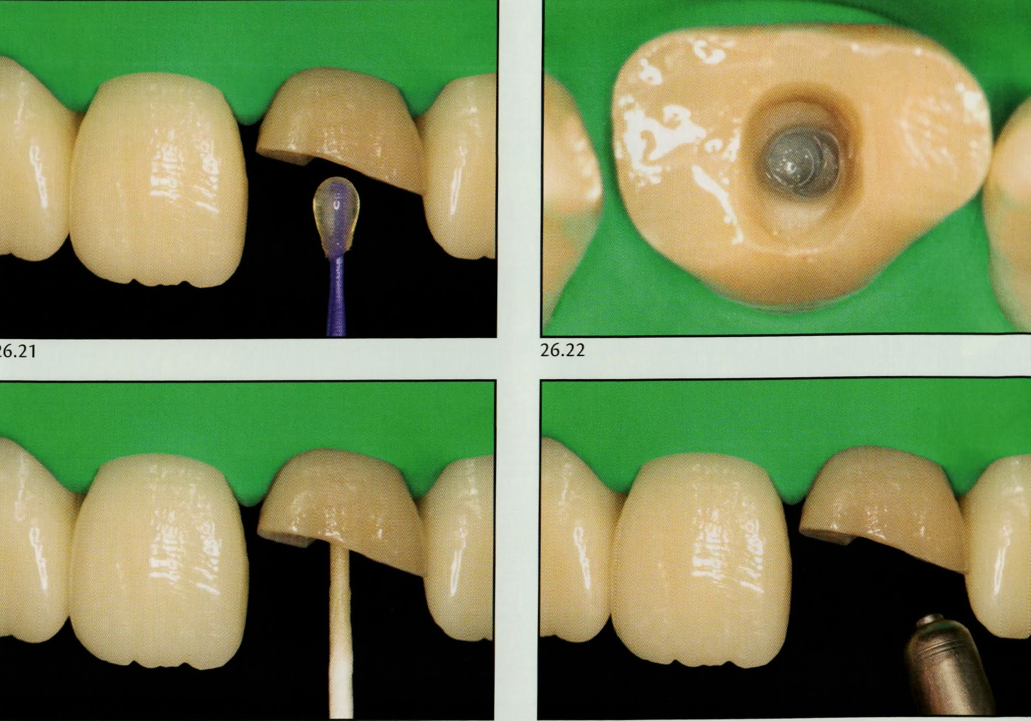How to cement a fiber post ? Dental Esthetics