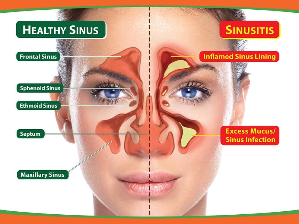 Home Remedies for Sinus Drainage