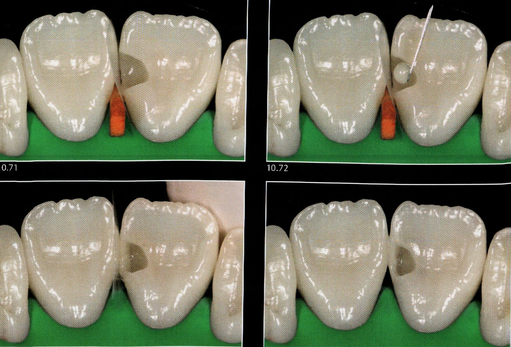 Class III composite restoration " Palatal access " Dental Esthetics