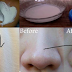 Home Remedy Trick You Can Use To Remove Ugly Blackheads and Pimple.