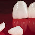 Thế nào là trồng răng sứ nguyên hàm? 