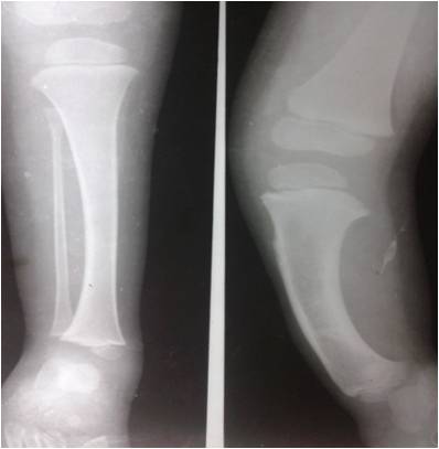 FIBULAR HEMIMELIA - Sumer's Radiology Blog