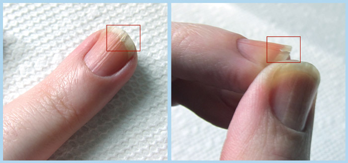 Nails split down the middle - Answers on HealthTap