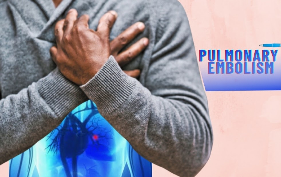 Pulmonary embolism causes, risk factors, signs and Symptoms