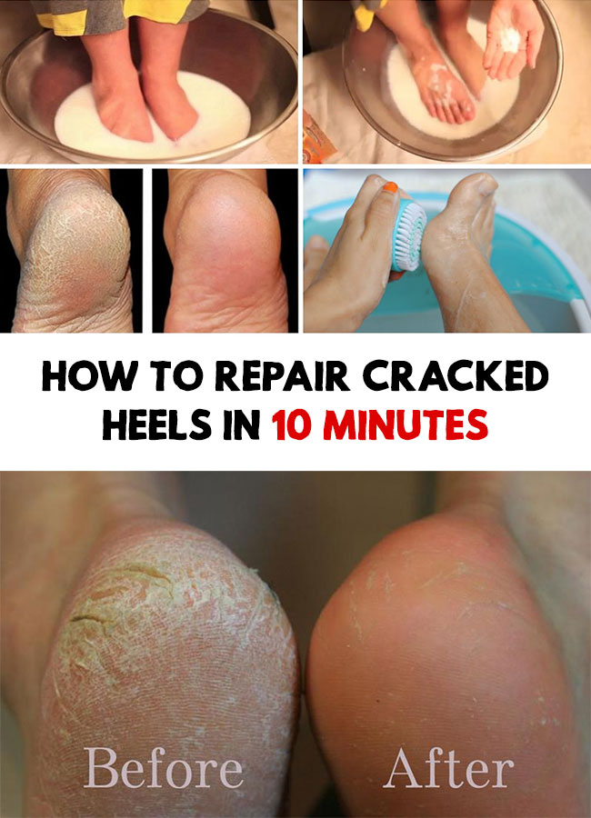 How To Repair Cracked Heels In 10 Minutes Healthcare Important
