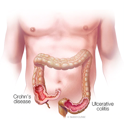 advances-treatment-crohns-disease-ulcerative-colitis-banner