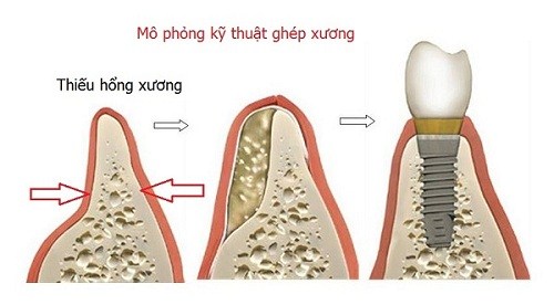 YẾU TỐ NÀO ĐẢM BẢO TRỒNG RĂNG IMPLANT ĐƯỢC THÀNH CÔNG -2