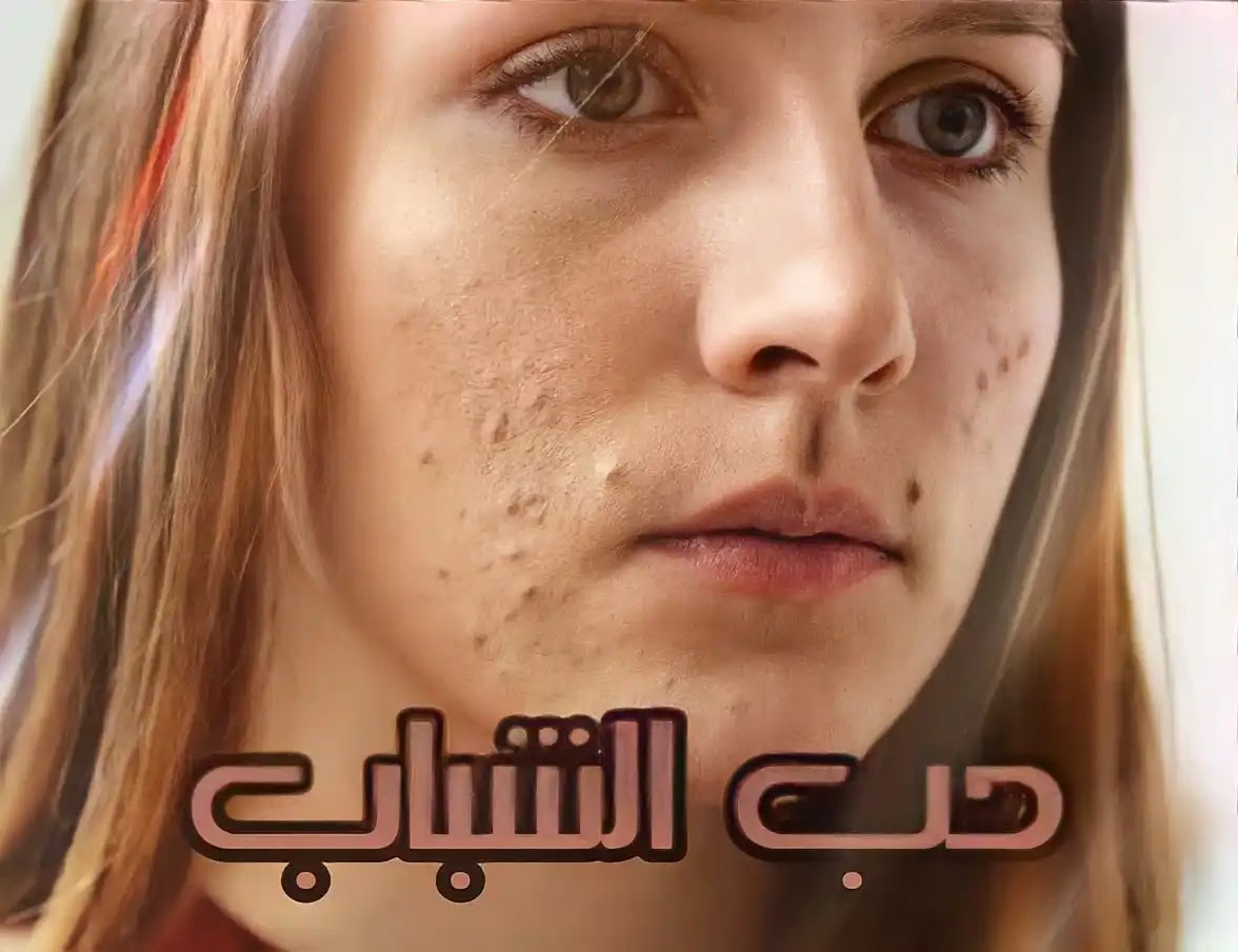 علاج حب الشباب في الوجه بسرعه نهائيا أسباب ظهور حب الشباب