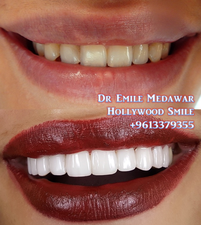 Hollywood Smile Lebanon, Beirut Dentist Dr Emile Medawar Great Hollywood Smile Veneers by Dr