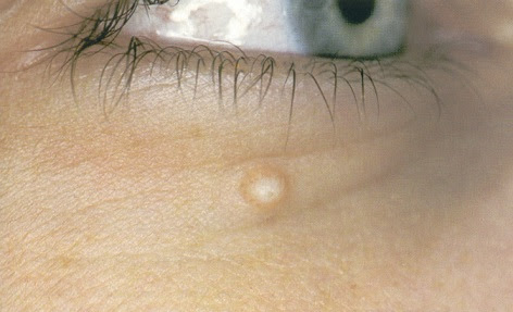 Λιπώματα: Γιατί πρέπει να τα χειρουργούμε