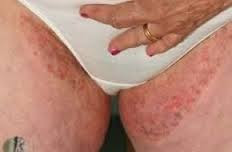 merk obat gatal pada selangkangan dan bokong di apotik terbukti paling ampuh 