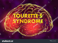 Sindrom Tourette 