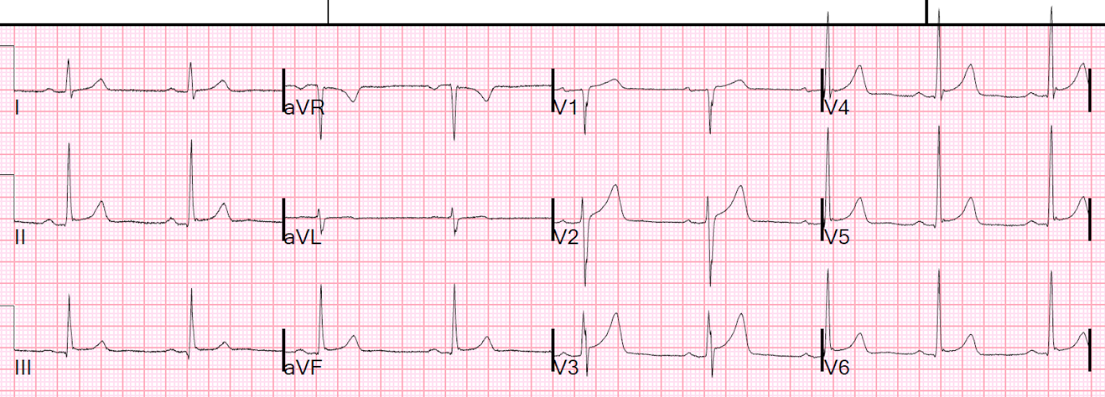 Dr. Smith's ECG Blog A 60something with syncope