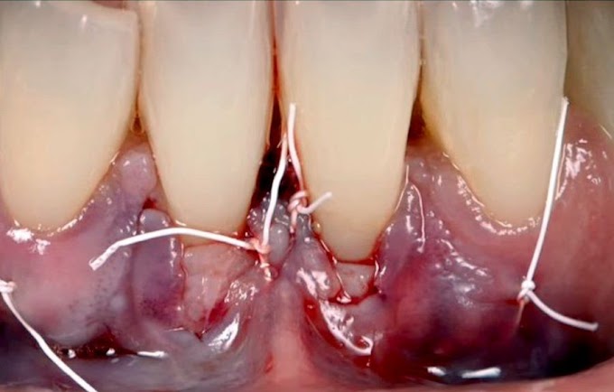 PERIODONCIA: Tratamiento Recesión Miller Tipo III