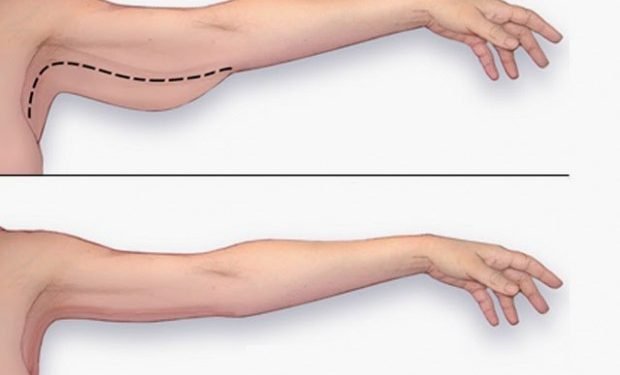 5 Exercises For Tonic Arms