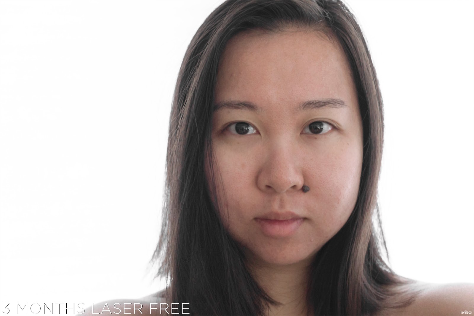 tria Hair Removal Laser Facial Hair 3 Months Laser Free