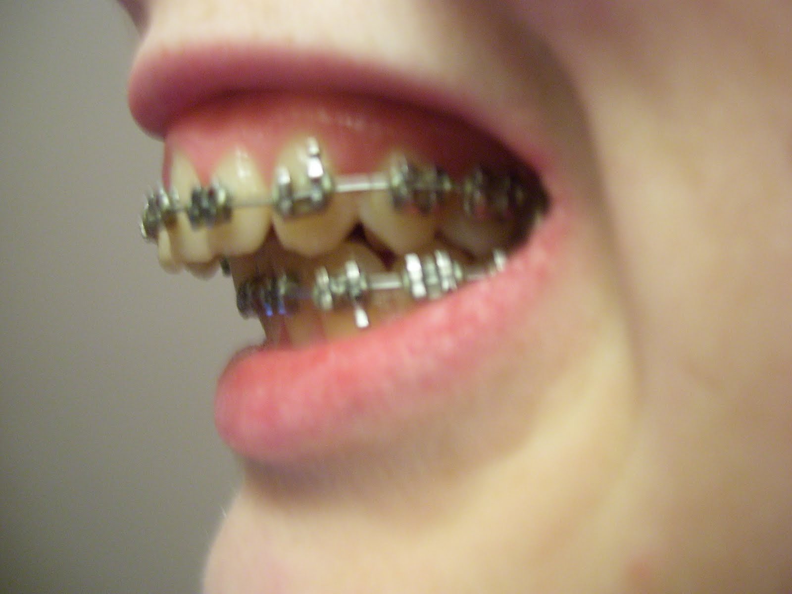 My Jaw Surgery Story 2 weeks of braces