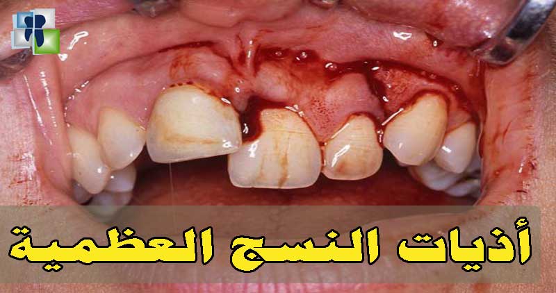 أذية العظم أثناء قلع الأسنان وطريقة العلاج والتدبير أذية العظم أثناء قلع الأسنان وطريقة العلاج والتدبير