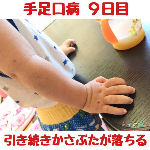 手足口病 赤ちゃん 子ども 湿疹 発疹 発熱 写真 記録
