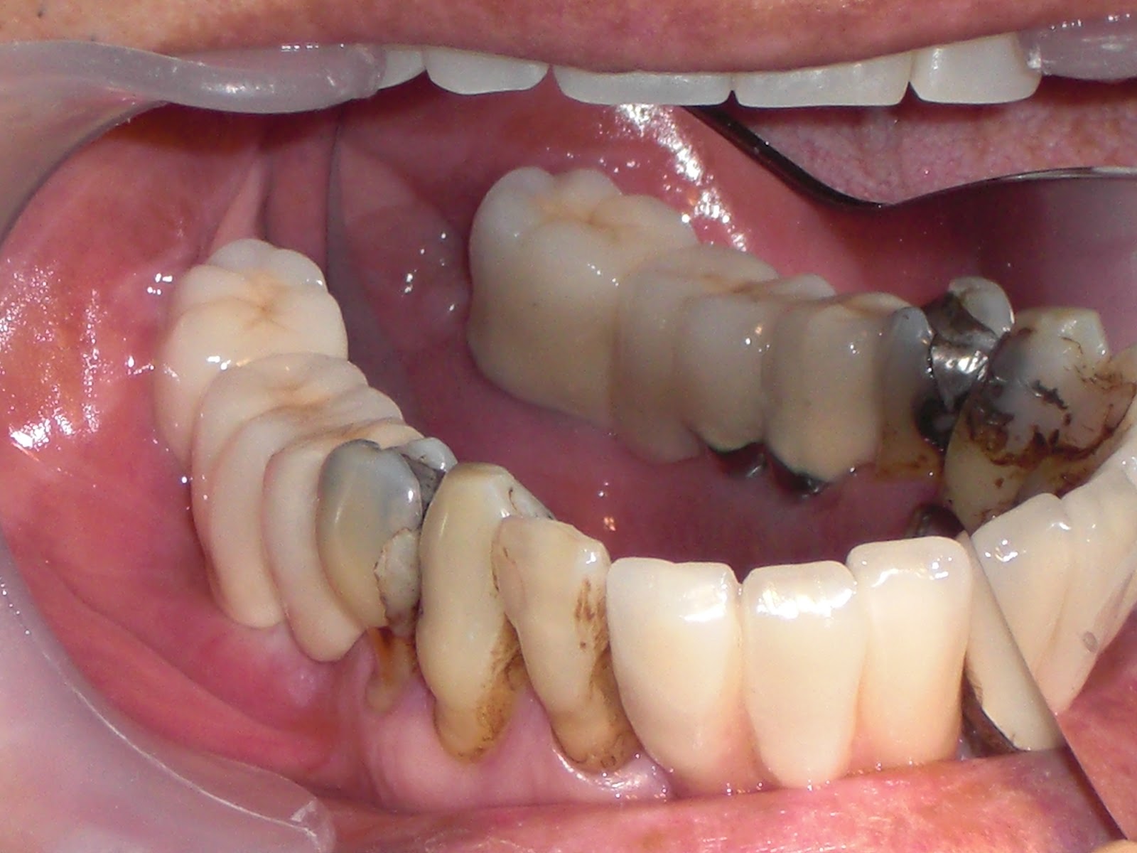 Dental Implantology: THE RESCUE OF A DENTAL CRIPPLE AND A LIFE TRANSFORMED