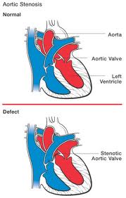 COCHIN CARDIAC CLUB: AORTIC STENOSIS