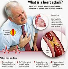 10 SYMPTOMS OF HEART ATTACK 10 SYMPTOMS OF HEART ATTACK