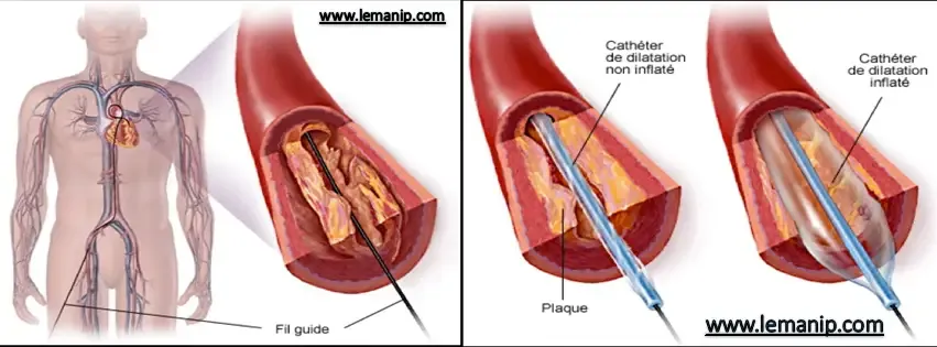 Angioplastie Coronaire :Préparation