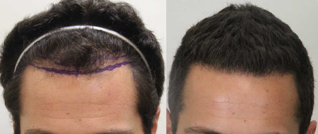 Best Hair Transplant Dallas - Revive Hair Restoration Dallas TX