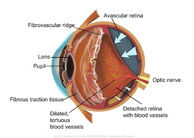 Medical illustration for African ocular project.