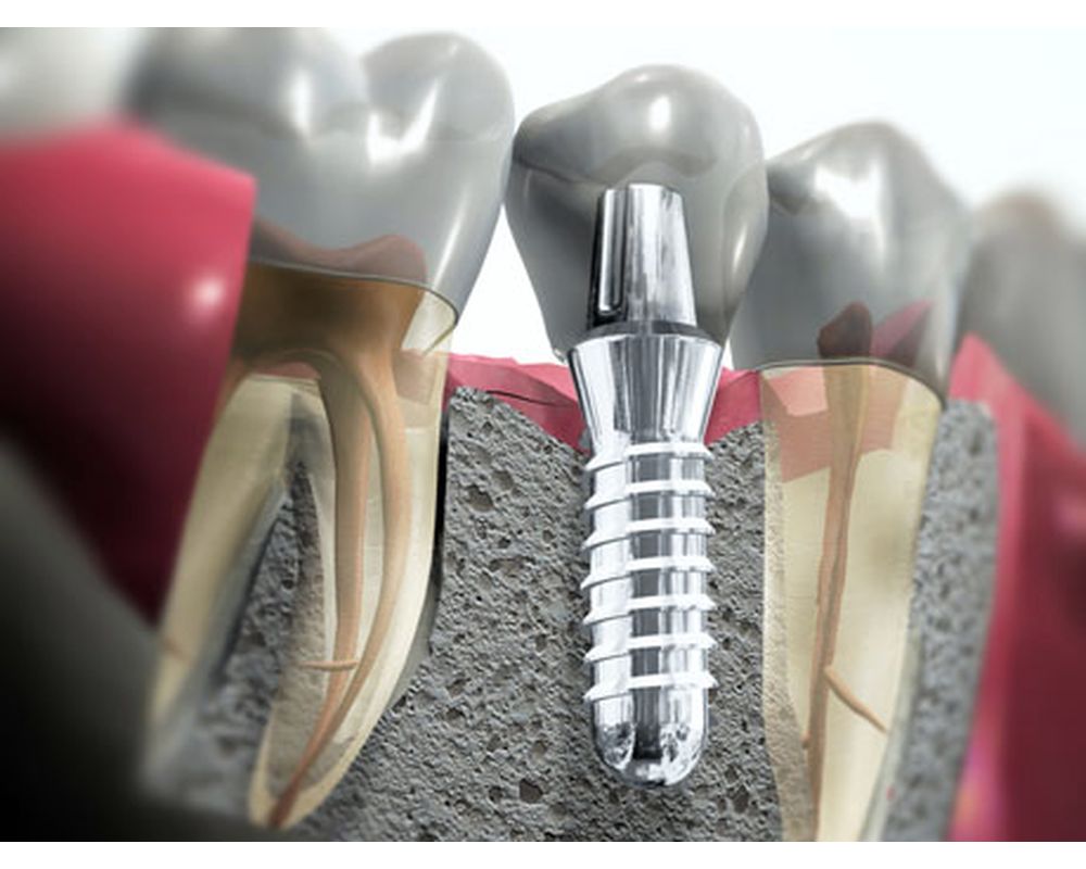 имплантация где дешевле. имплантанты 2 по цене 1. расценки на имплантация зубов. имплантация где дешевле. имплантация зубов реклама.
