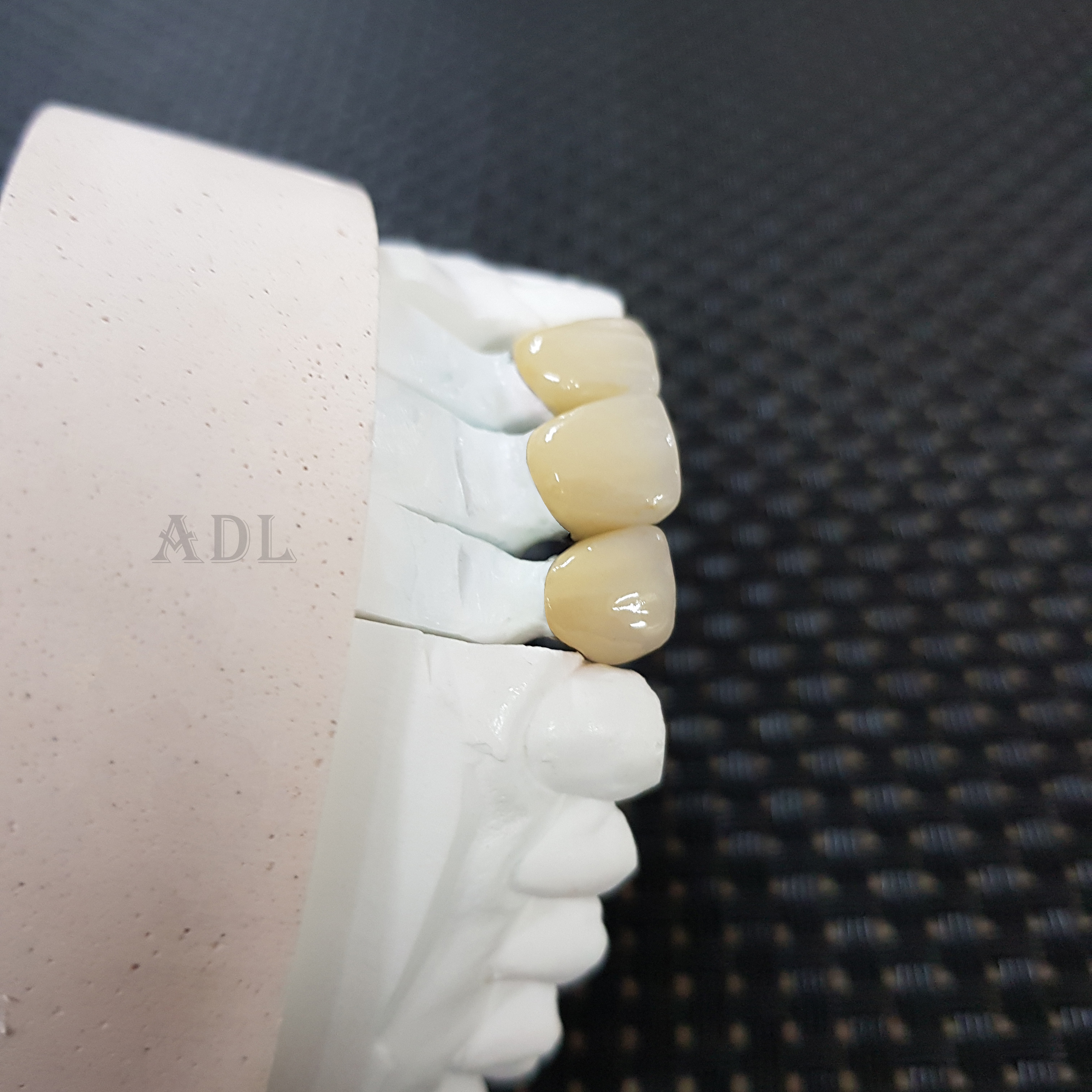 Dental Gold Ceramic