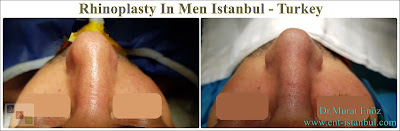 Rhinoplasty In Men,Rhinoplasty In Istanbul,Rhinoplasty In Turkey, Nose Job For Male, Male Nose Job in Turkey