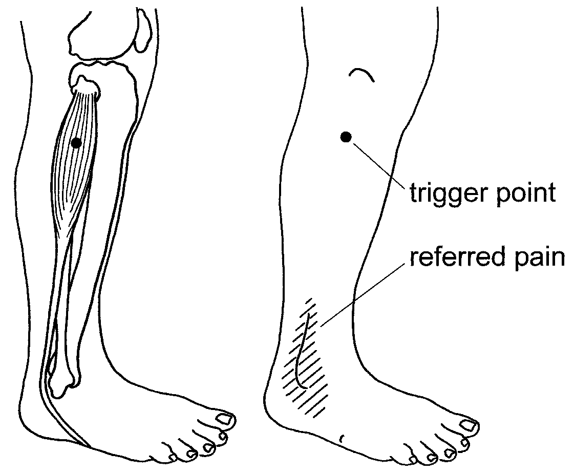 My Tips Point Leg Pain Causes and Solutions