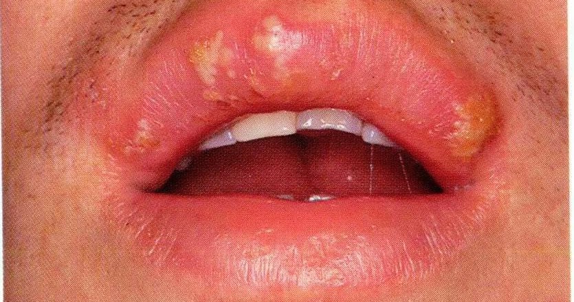 Mouth Sores and Lip Conditions: Conditions, Treatments ...