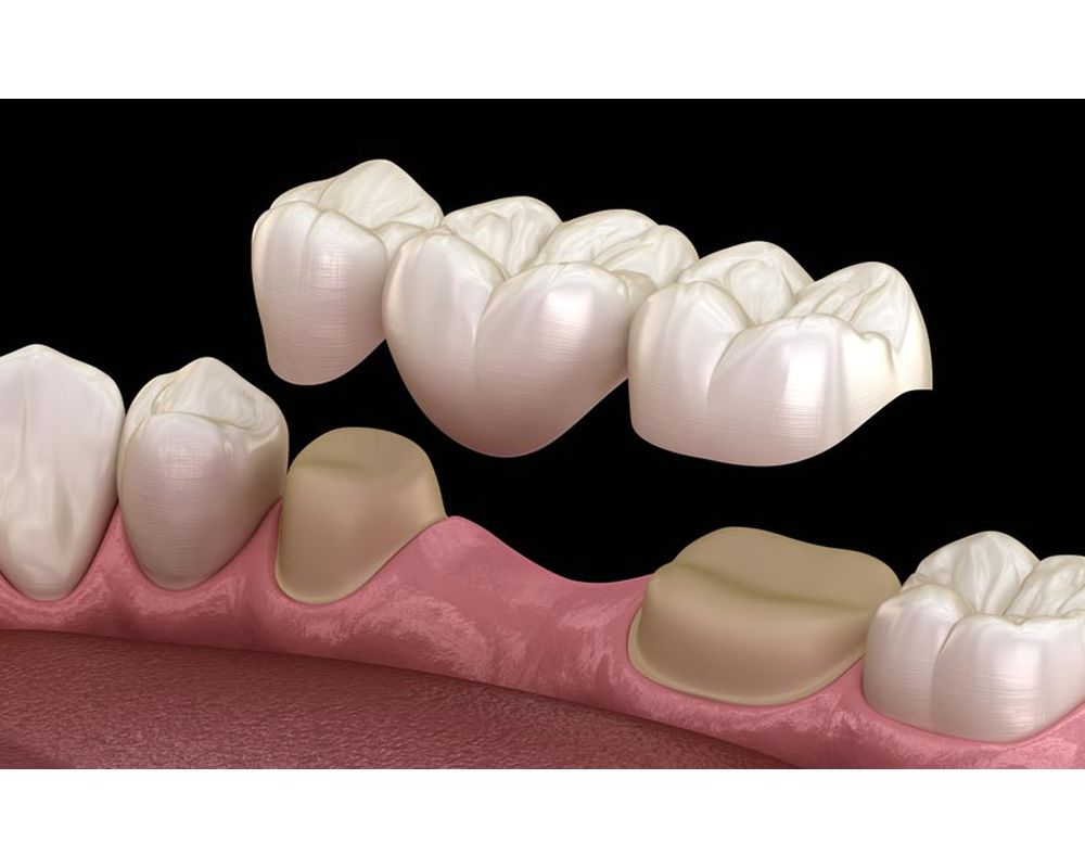 Prótesis Dental