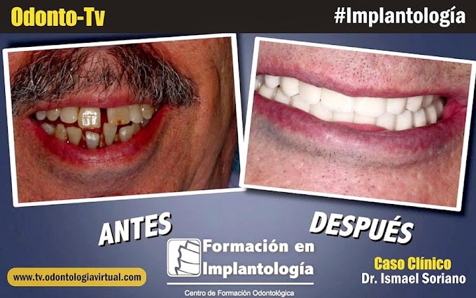 IMPLANTOLOGÍA: Rehabilitación con 12 implantes - Caso Clínico del Dr. Ismael Soriano