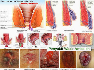 Foto Tanaman obat untuk wasir berdarah yang ampuh
